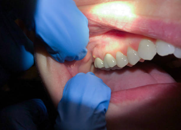 Best Emergency Dentist for Lost Fillings or Crowns in Holiday Shores, IL