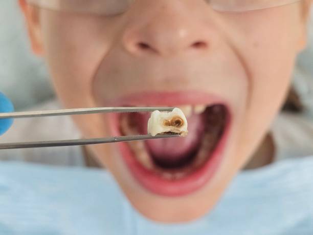 Best Emergency Dentist for Lost Fillings or Crowns in Holiday Shores, IL